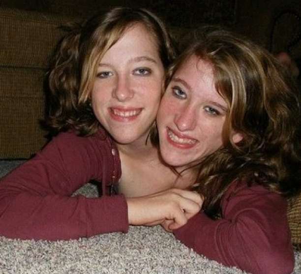 Abby et Brittany Hensel : des jumelles siamoises qui ont acquis une renommée internationale
