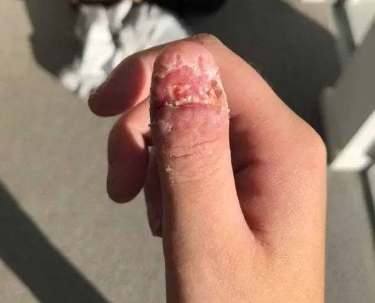Cette jeune fille a développé un cancer de la peau à force de se ronger les ongles.