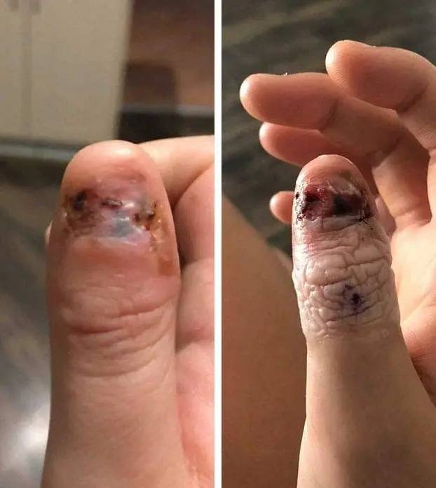Cette jeune fille a développé un cancer de la peau à force de se ronger les ongles.