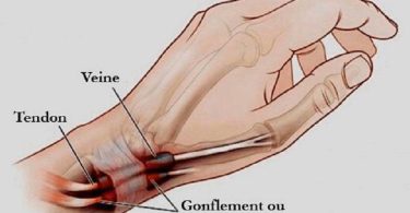 La ténosynovite : l’inflammation des pieds et des mains que vous devez connaitre