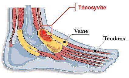 La ténosynovite : l’inflammation des pieds et des mains que vous devez connaitre