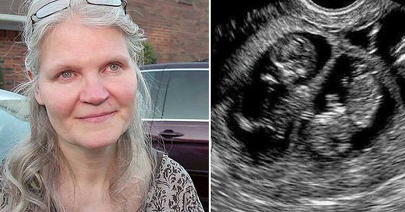 Cette femme de 42 ans est enceinte de triplés, donnant naissance à des quadruplés