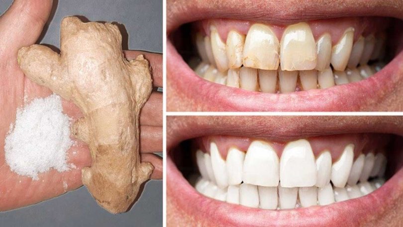 Le gingembre et le sel permettent de blanchir les dents : voici comment les utiliser