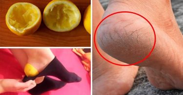 Comment obtenir des pieds doux avec du citron ?