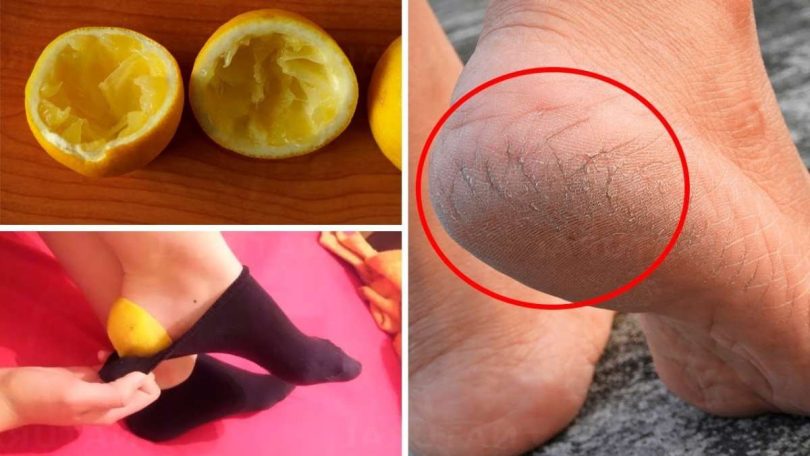 Comment obtenir des pieds doux avec du citron ?